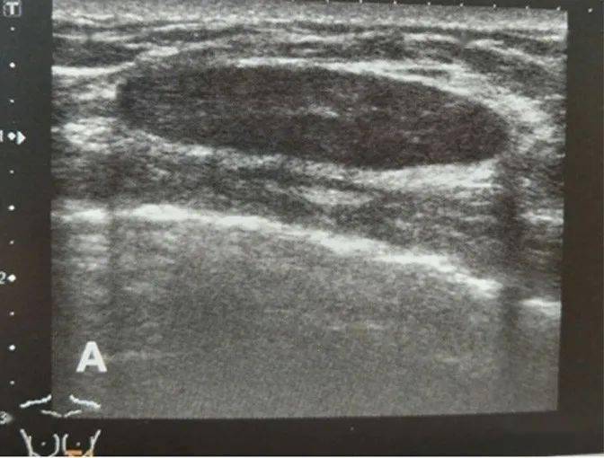 乳腺单发或多发囊肿,多为圆形或椭圆形无回声,边界清楚,囊壁薄而光滑