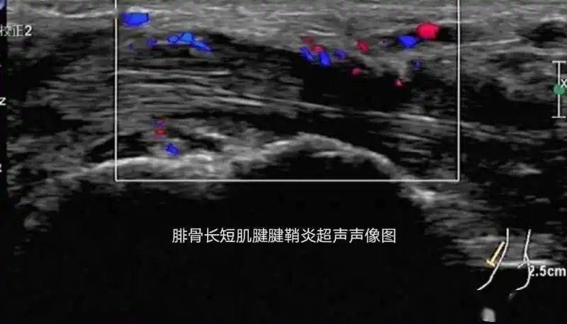超声科二区开展可视化超声引导肌骨神经疼痛注射治疗