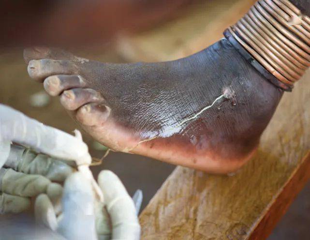 非洲寄生虫疾病:1米多长寄生在体内,为了繁殖才钻出皮肤