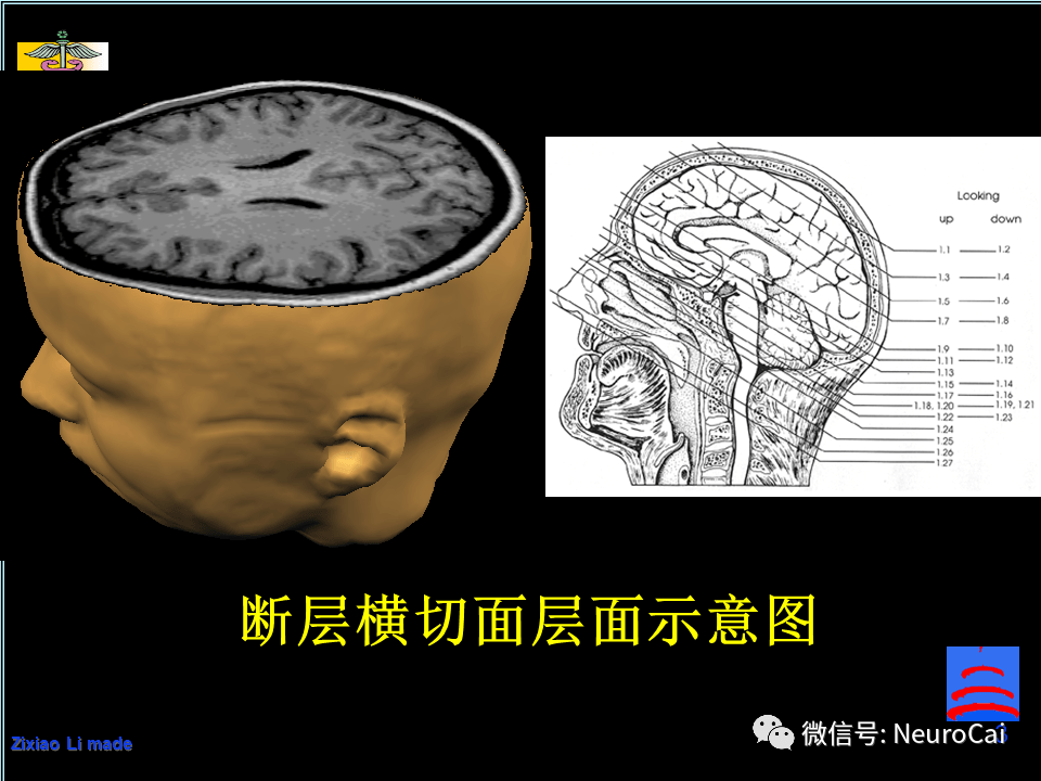 影像解剖 | 脑局部解剖与功能图谱_头皮