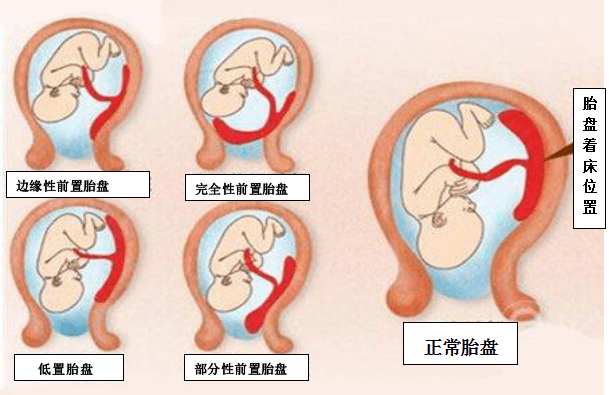 低置胎盘.
