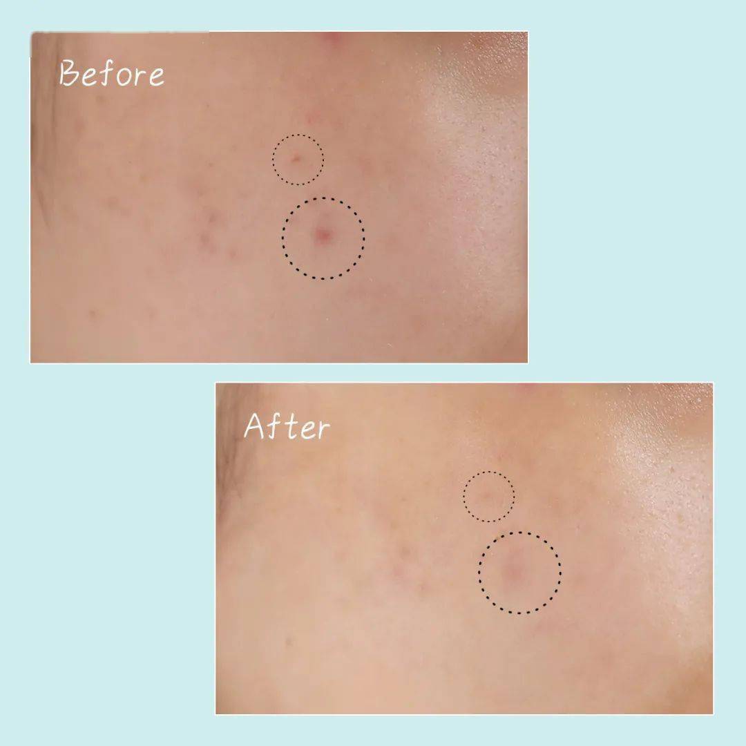 读者|冒痘、泛红、过敏……夏日最需要的保湿舒缓好物都在这一篇! | 读者说