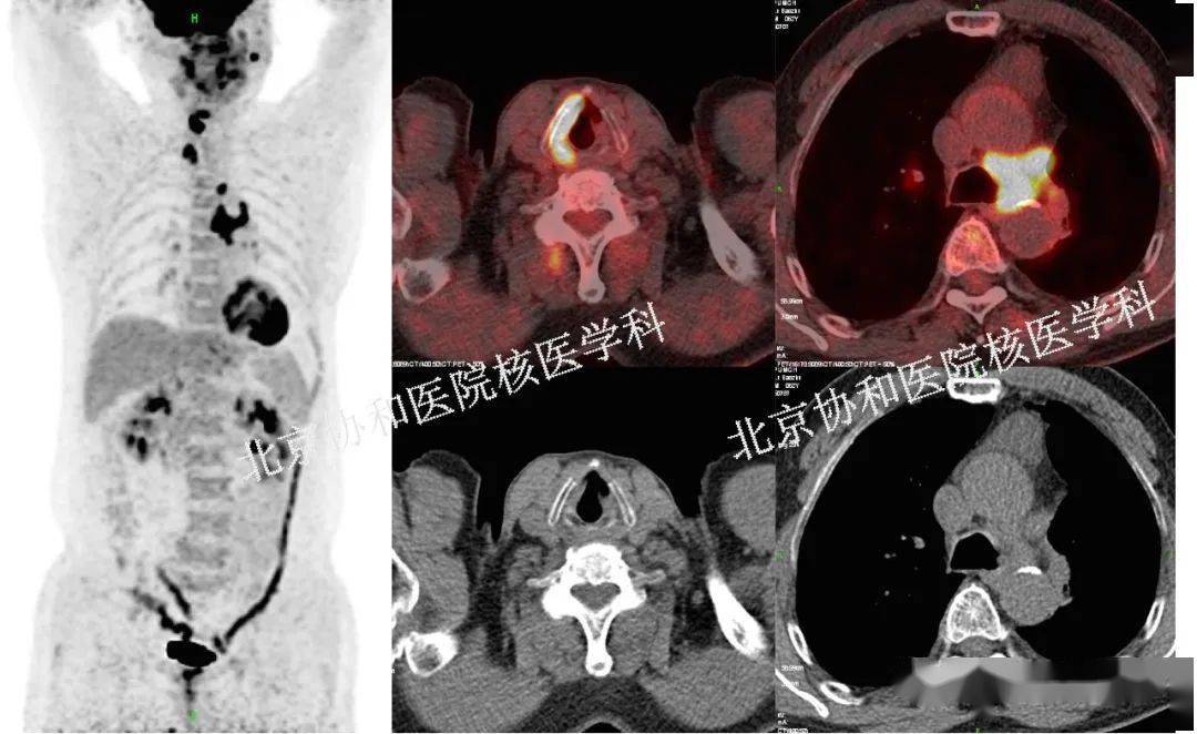 【分享】18f-fdg pet/ct | 肌肉代谢的复仇