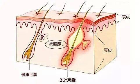 毛孔粗大还能再抢救一下