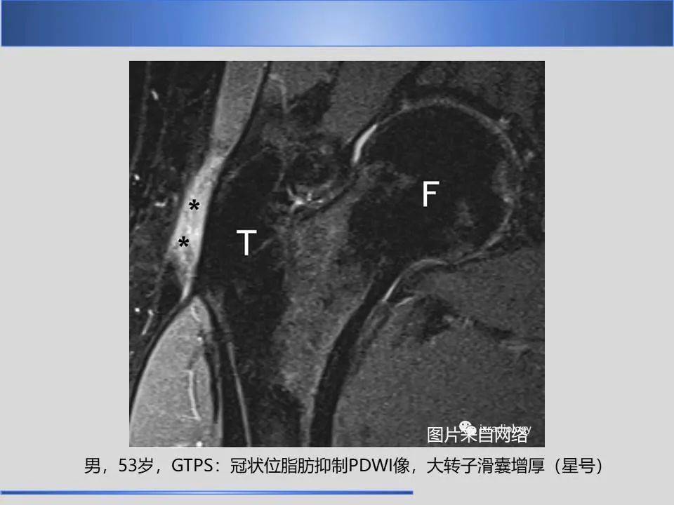 股骨大转子疼痛综合征mr特征