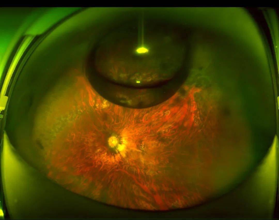 黄斑裂孔：同一患者双眼不同时期的巧遇与手术治疗的奇迹 - 知乎