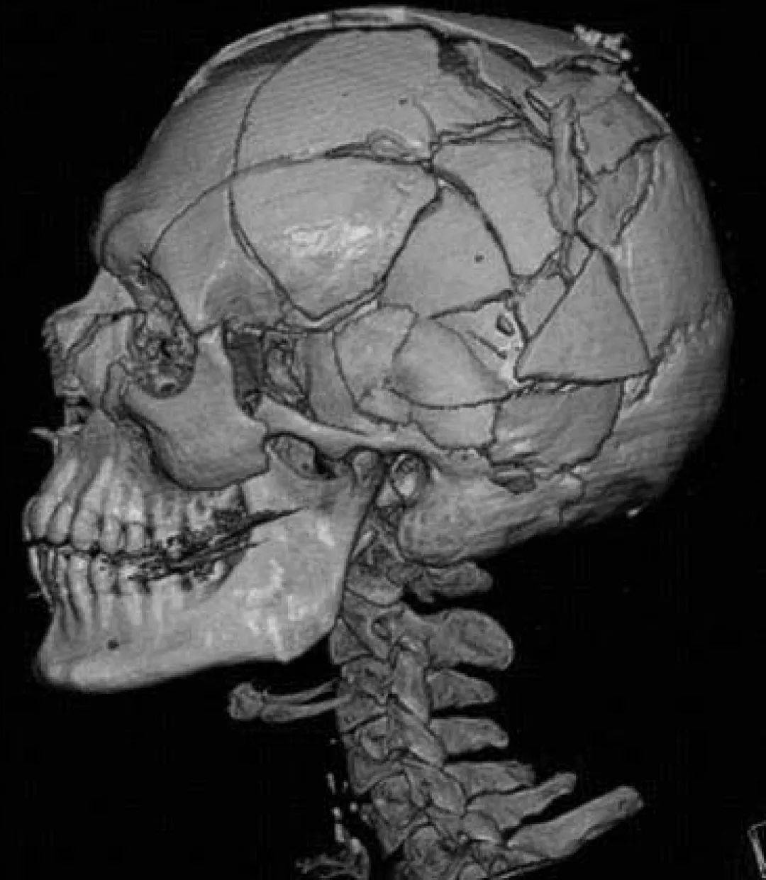 虚拟尸检对复杂颅骨骨折的清晰呈现丨参考文献3