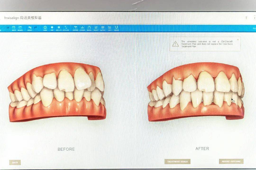 口腔|摘掉口罩也自信，暑期明星同款隐适美牙齿矫正直接半价！