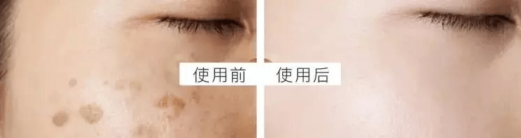 皮肤|用它点一点，痘印、斑点竟然没了，难怪李佳琦都为它疯狂打call！