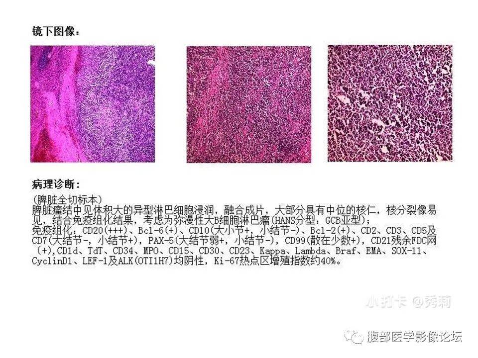 脾脏丨弥漫性大b细胞淋巴瘤两例