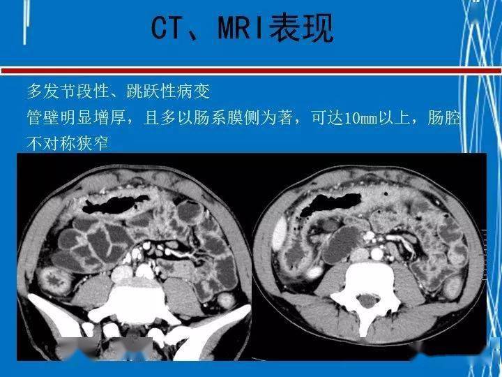 克罗恩病ctmri表现及鉴别诊断