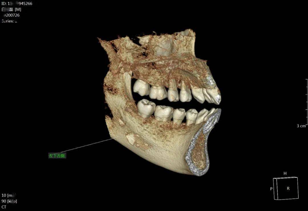 紧邻38牙胚,波及同侧神经管,舌侧及下颌骨下方骨板少量剩余,35畸形