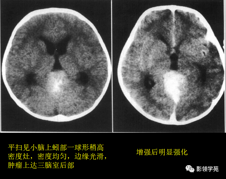 单发多见ct表现:(1)平扫见小脑或者脑干低密度囊性肿 块,可呈球形