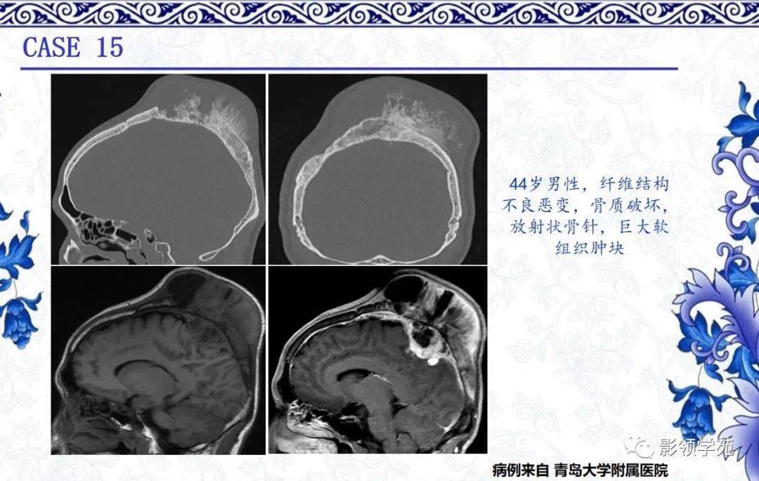 受累骨膨胀 病变组织棕灰色 质地多呈均匀坚硬或沙砾样 内可有含黄色