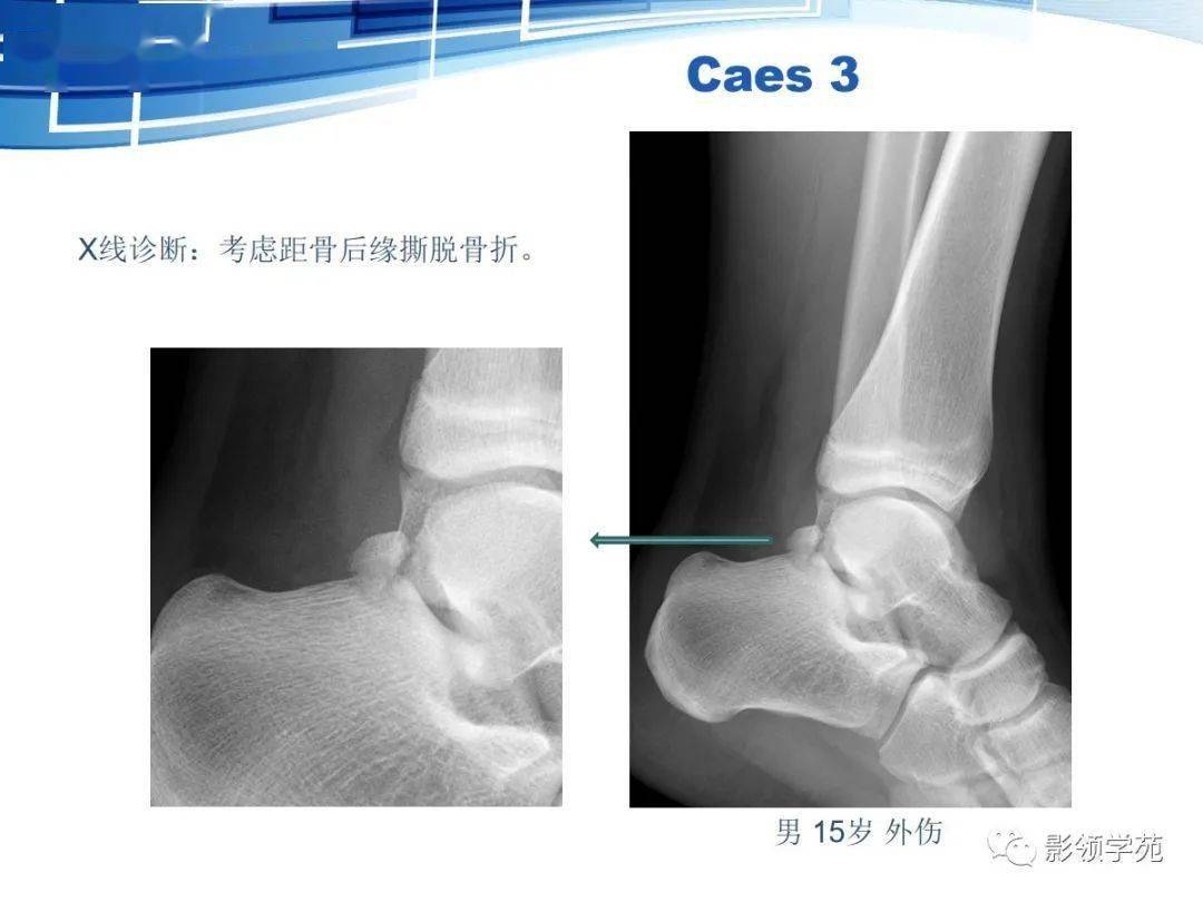 呈三角形 与距骨后缘相切,三角骨与距骨后突外侧结节腓侧隐窝相对应.