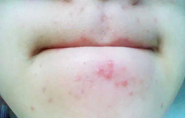 灭火器|1滴让你爱上!从满脸爆痘到光滑无瑕,我只用了这瓶火爆ins的“痘痘灭火器”!