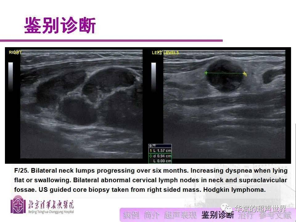 病例和文献阅读:颈部神经鞘瘤