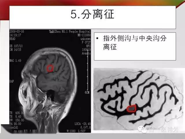 如何在ct及mri图像上辨识脑沟回