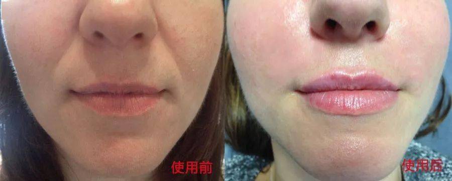 皱纹|抗皱抗衰老还在打针?用它赶走三八脸、鱼尾纹,让小朋友见到你都喊姐姐!