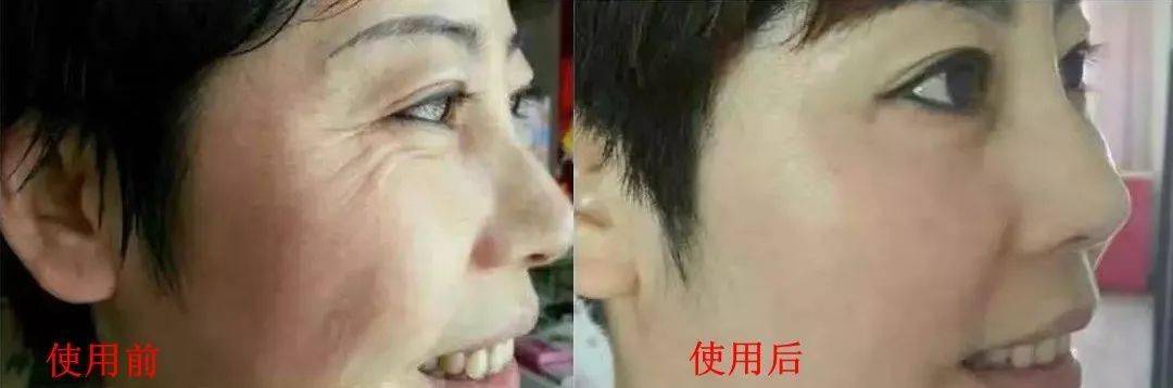 皱纹|抗皱抗衰老还在打针?用它赶走三八脸、鱼尾纹,让小朋友见到你都喊姐姐!