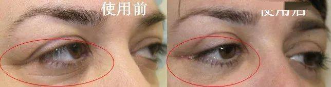 皱纹|抗皱抗衰老还在打针?用它赶走三八脸、鱼尾纹,让小朋友见到你都喊姐姐!