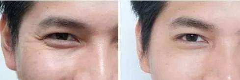 皱纹|抗皱抗衰老还在打针?用它赶走三八脸、鱼尾纹,让小朋友见到你都喊姐姐!