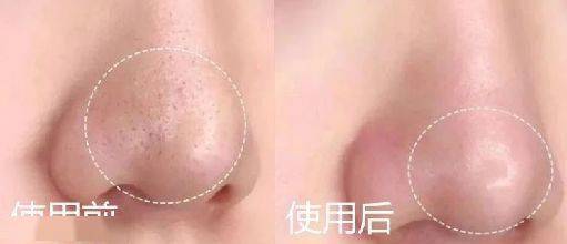 肌肤|脸上挤出的“白浆”是什么？原来是它作怪！出油、过敏也因此而起！