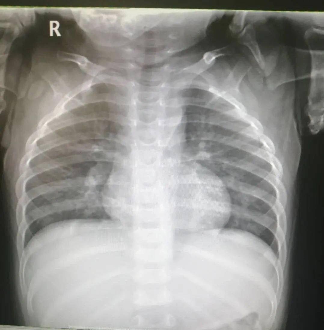 门诊胸片如下图所示: 入院后初步诊断为:支气管肺炎.
