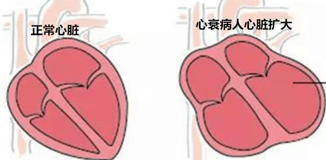 怎么能让心脏衰竭 447fb916148048449dea4d938de63a59.png