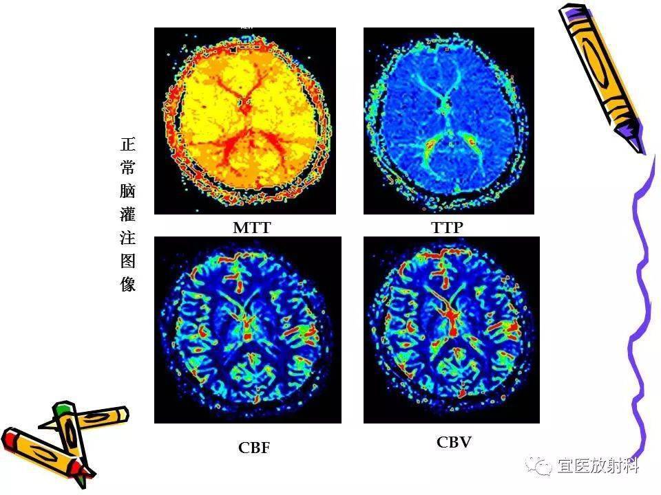 脑灌注成像在脑缺血性病变中的临床应用