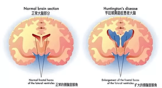 【瑞健国际】科普|罕见病亨廷顿病的遗传方式_基因