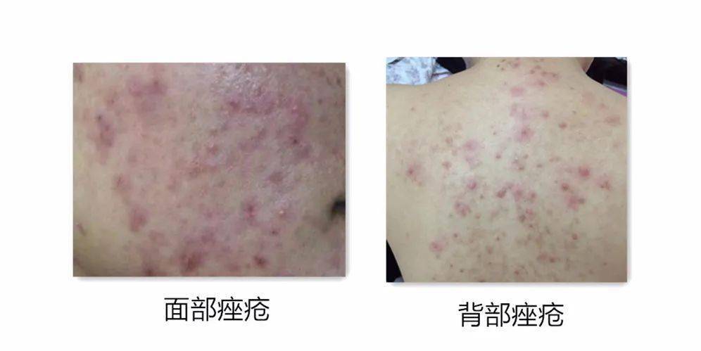 寻常型痤疮