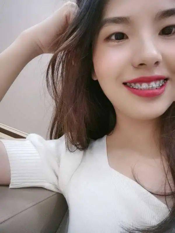 龅牙|广州95后女生从小龅牙，嘴巴都快闭不上！朋友却劝她不要矫牙，一年后......