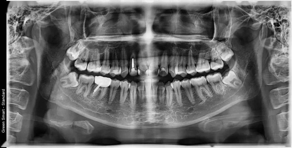 龅牙|广州95后女生从小龅牙，嘴巴都快闭不上！朋友却劝她不要矫牙，一年后......