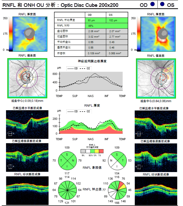 左眼(虚线)落在黄色及红色范围内,表明左眼rnfl厚度降低; 鼻下区域