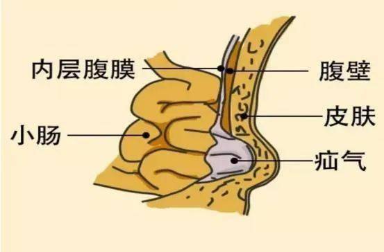 如下图,当咳嗽,哭闹等腹腔压力增高时,腹腔内的脏器(小肠,网膜,女孩