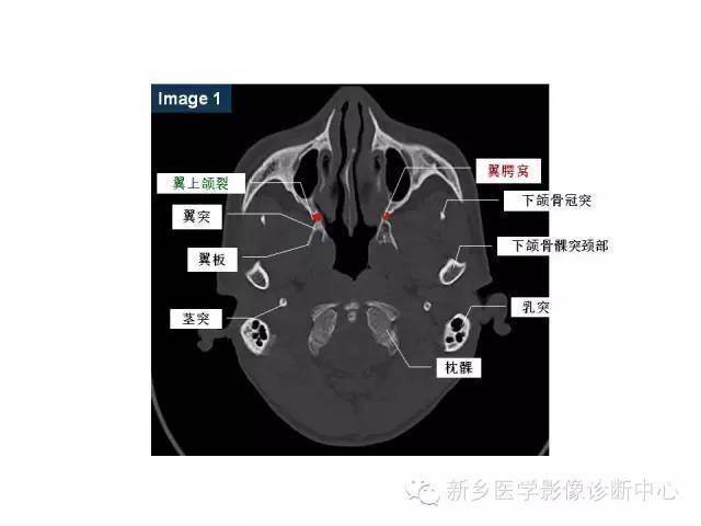 颅底详细断层解剖