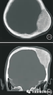 鉴别诊断:  1,颅骨骨瘤:多见于颅骨外板,无痛,广基底,病变局部呈圆形