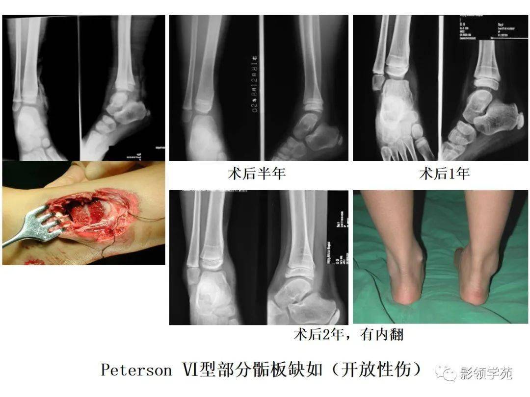 儿童骨骺损伤影像诊断