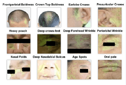 看脸可识冠心病！欧洲心脏杂志发表阜外医院郑哲团队多中心机器学习文章