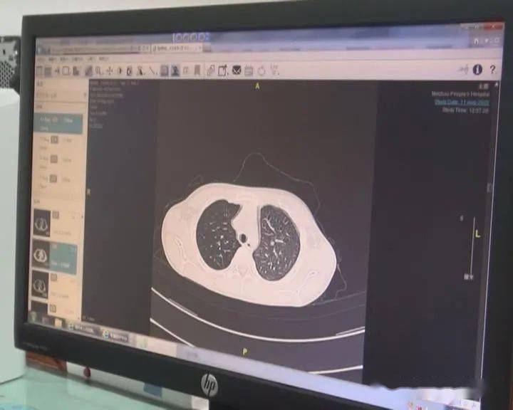 南瓜子|孩子的这些动作一定要制止！7岁女童气管内竟“长出”2厘米南瓜子