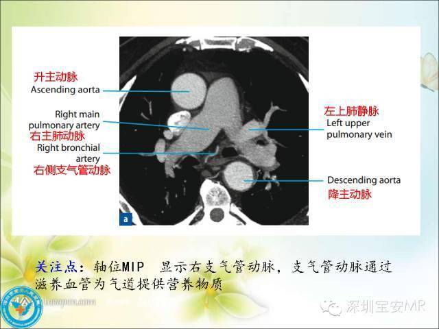 解剖心脏大血管丨肺动脉和肺静脉影像断层解剖