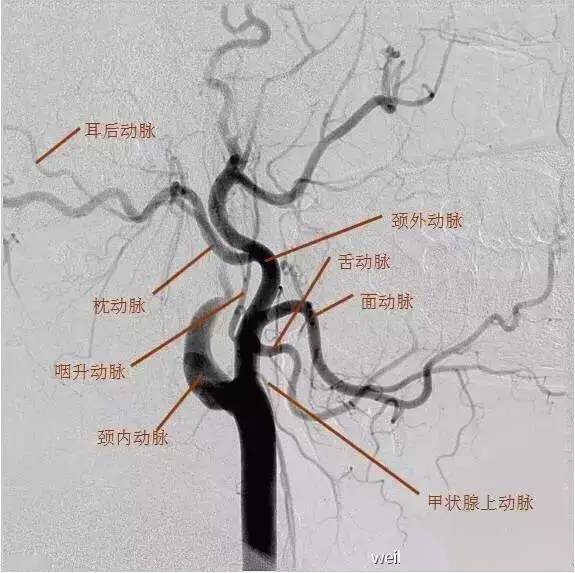 图6颈外动脉解剖dsa图