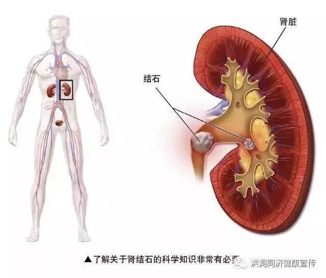 肾和输尿管结石的临床表现诊断和鉴别诊断