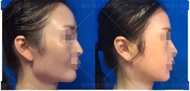 "歪脸女孩"美丽蜕变,这样的整形手术是怎么做到的?