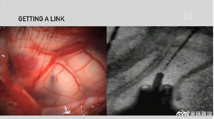 新进展|马斯克展示脑机接口新进展：植入猪脑，硬币大小，无线传输