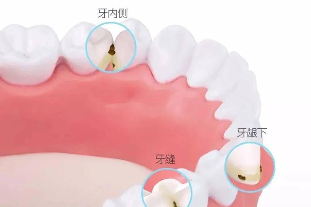 食物残渣|到底有多重要？你有一口好牙
