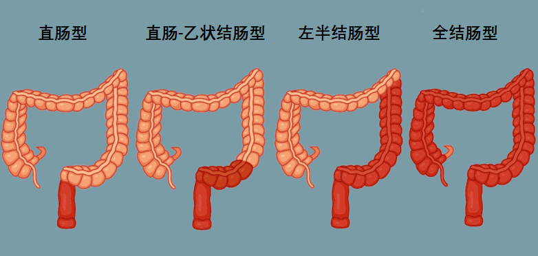 症状|【健康聚焦】让安倍辞职的“绿色癌症”，年轻人高发！有这些情况尽快检查