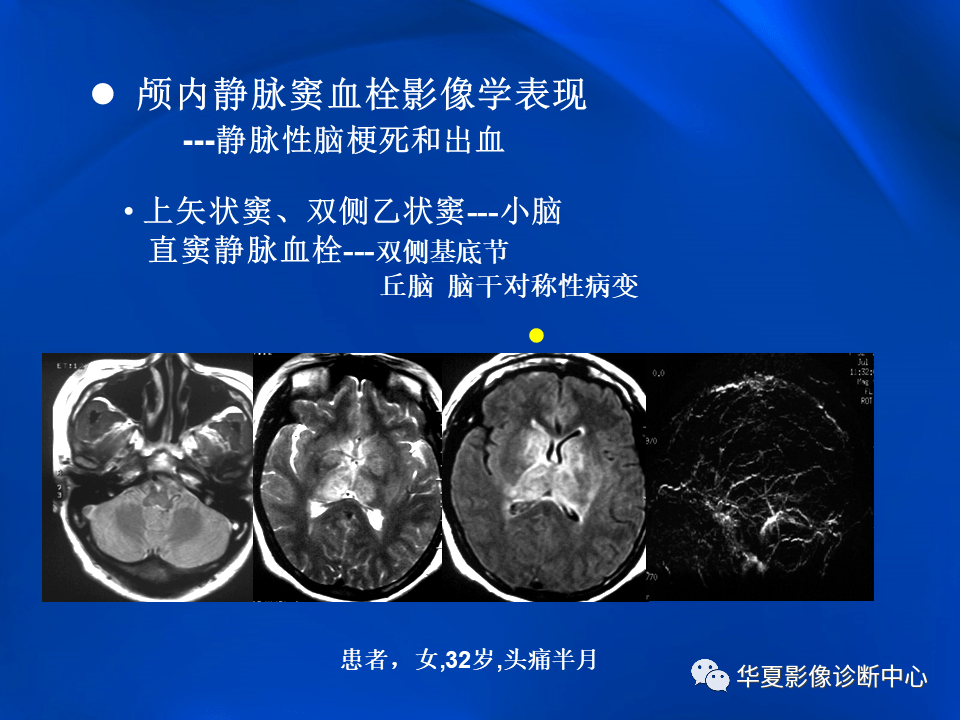 学习不倦颅内静脉窦血栓形成的影像学表现