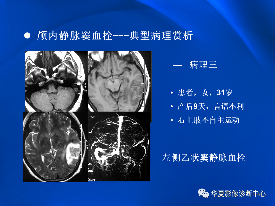 学习不倦颅内静脉窦血栓形成的影像学表现